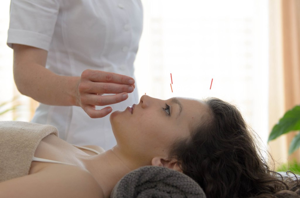 needling age out with acupuncture